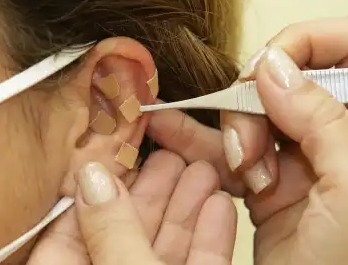 Auriculoterapia